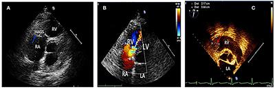 Case report: Different clinical manifestations of the rare Loeffler endocarditis